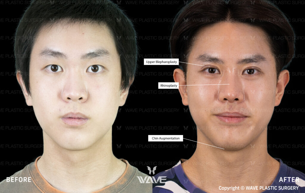 male plastic surgery patient