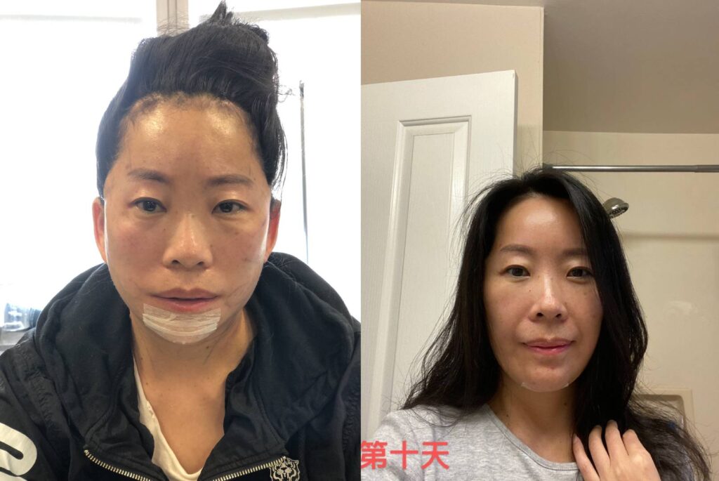 Plastic Surgery Recovery Stage
