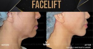 WAVE Plastic Surgery - Orange County - Facelift - Rhytidectomy