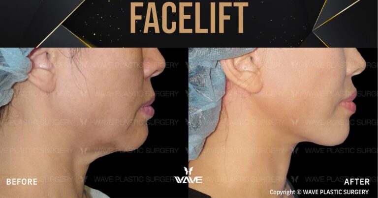 WAVE Plastic Surgery - Orange County - Facelift - Rhytidectomy
