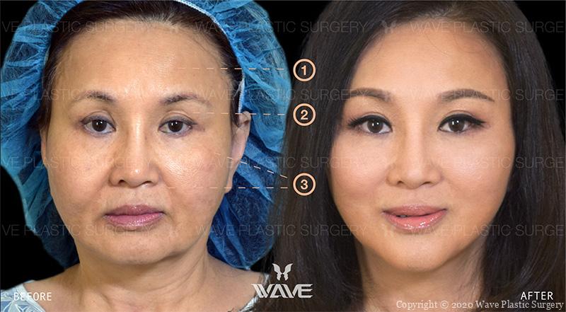Finding the Best Facelift Surgeon in Los Angeles Group 41 800 1