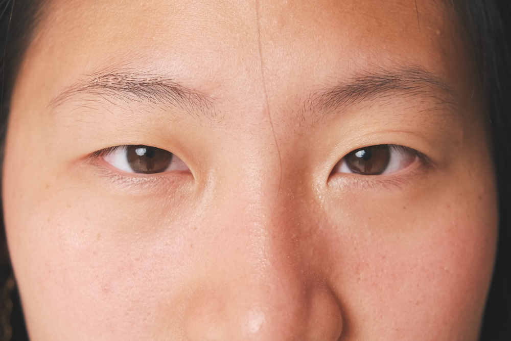 Close-up of woman's uneven eyelids