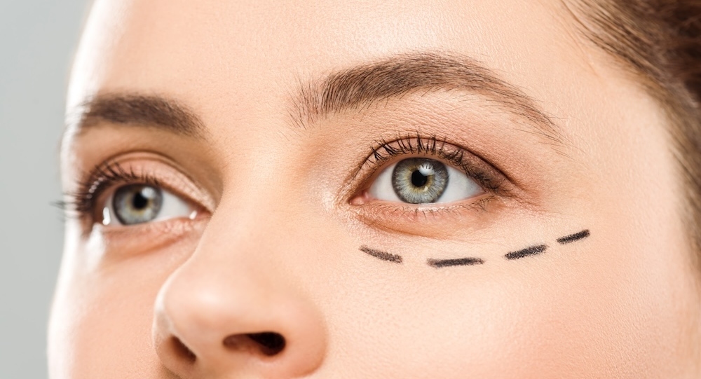Woman with marks on face near the eyes