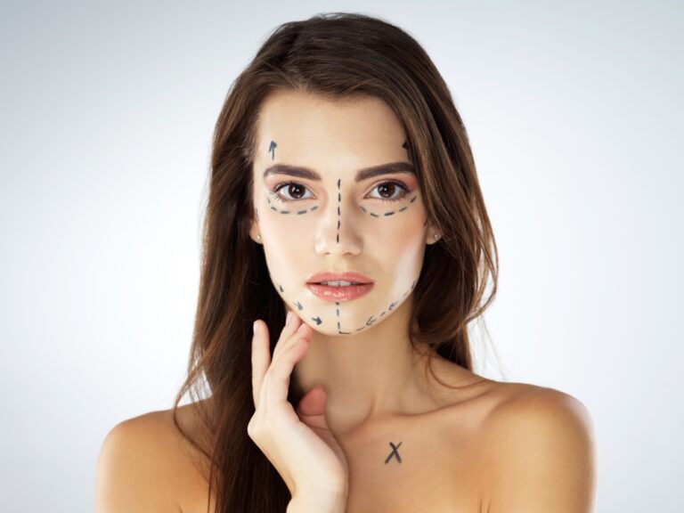 Woman with marks on her face for facial procedure.