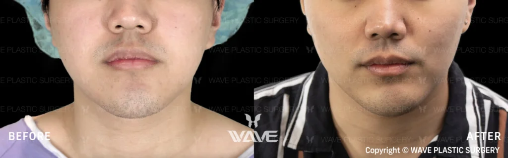 Face Contouring Buccal Fat Removal