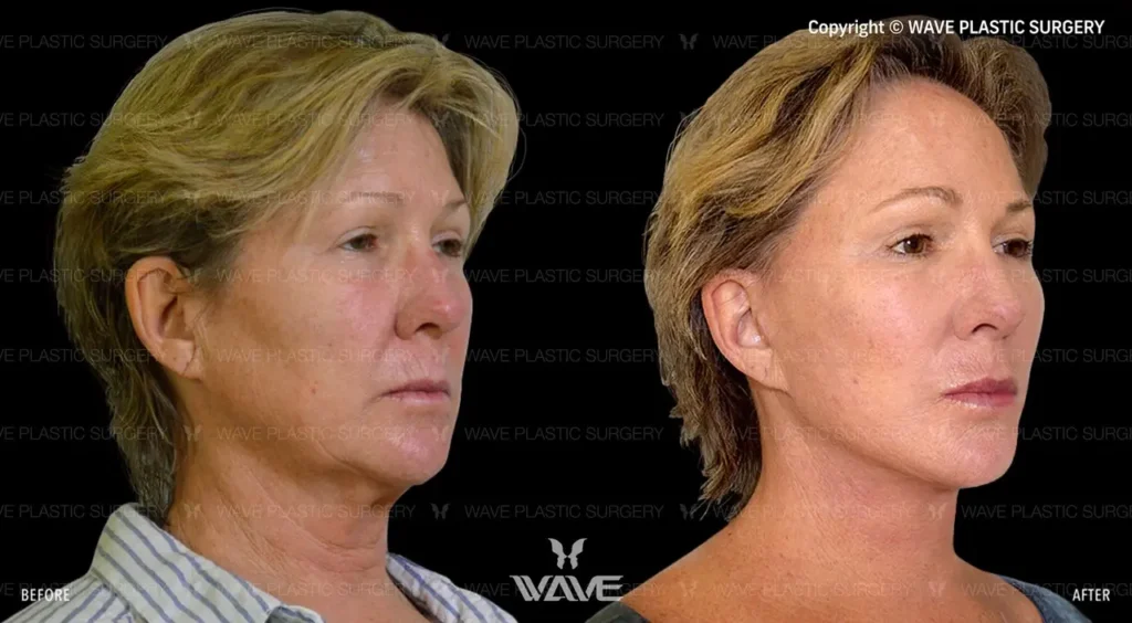 How to Prepare for a Facelift: A Comprehensive Guide Facelift 02 Large
