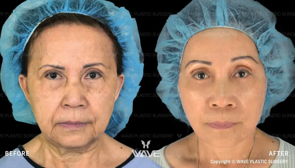 How to Prepare for a Facelift: A Comprehensive Guide Facelift 03 Large