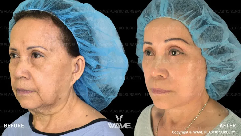 How to Prepare for a Facelift: A Comprehensive Guide Facelift 04 Large