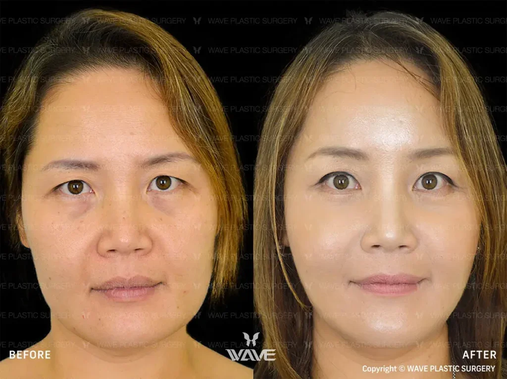 Types of Facelifts: A Guide to Your Surgical and Non-Surgical Options Facelift 06 Large