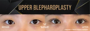 Upper Blepharoplasty Before and After Photo