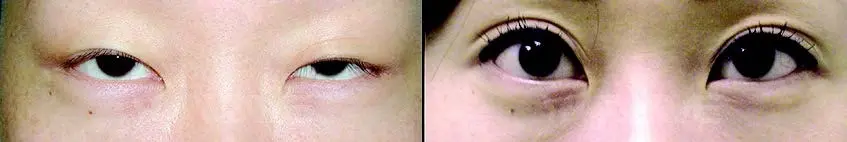 Ptosis Surgery Upper Bleph 07