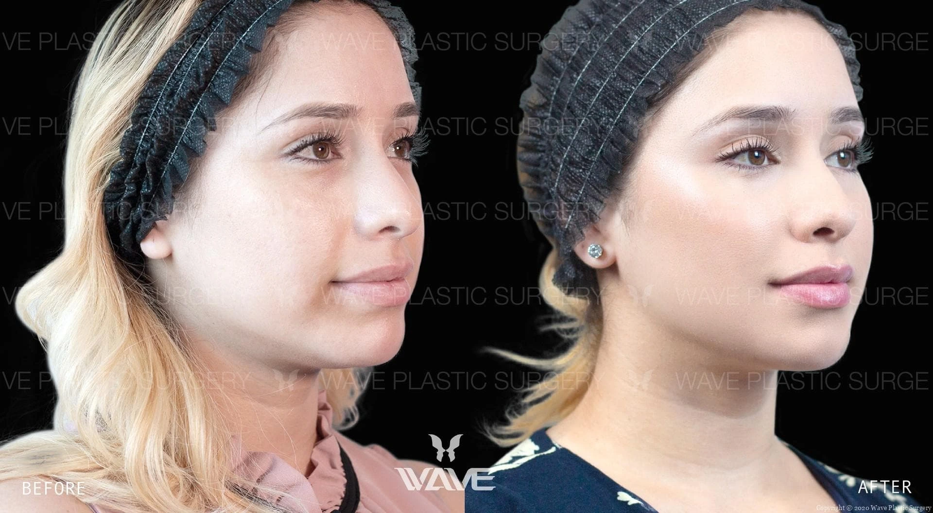 Wave Plastic Surgery and Aesthetic Center - Restylane