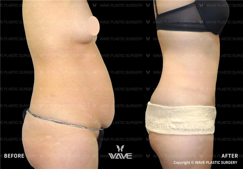 Wave Plastic Surgery and Aesthetic Center - before and after body contouring