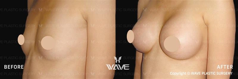 Wave Plastic & Aesthetic Center - before and after photo - breast augmentation