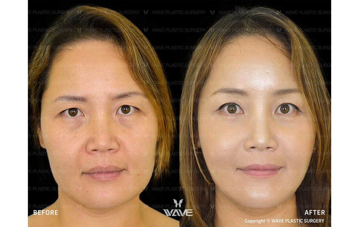 Before and After Facelift at Wave Plastic Surgery