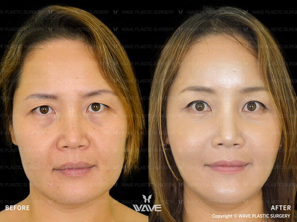 Facelift for Younger Patients: How Young is Too Young? Facelift 6