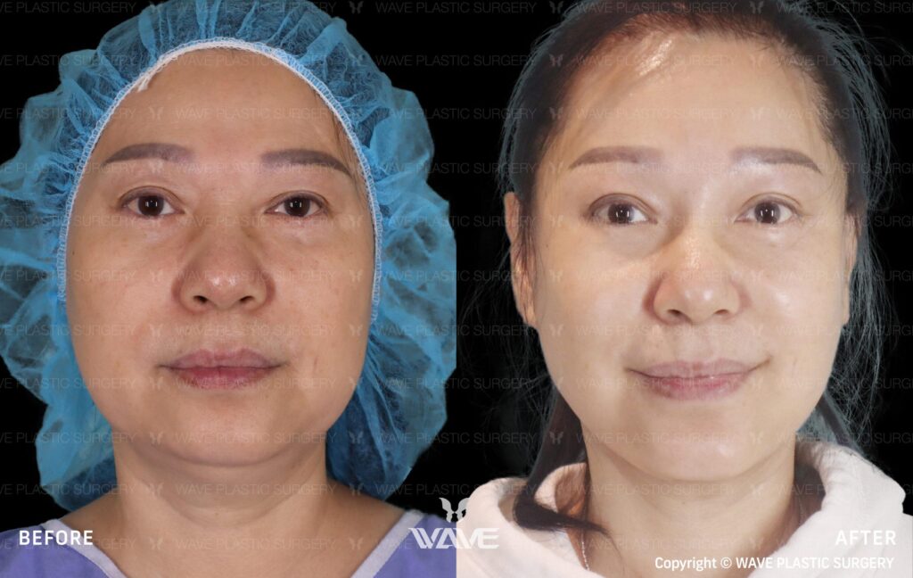 Facelift for Younger Patients: How Young is Too Young? Facelift 9