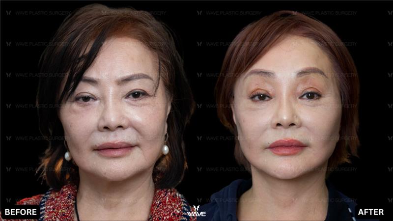 surgical_nonsurgical - before and after photo