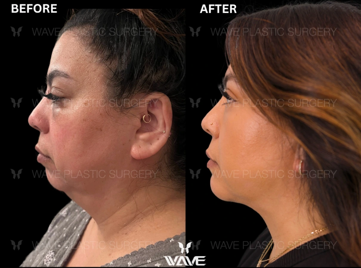 Wave Plastic Surgery - chin augmentation