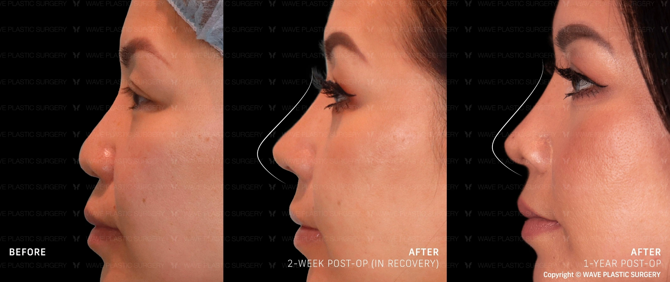 Wave Plastic Surgery - rhinoplasty