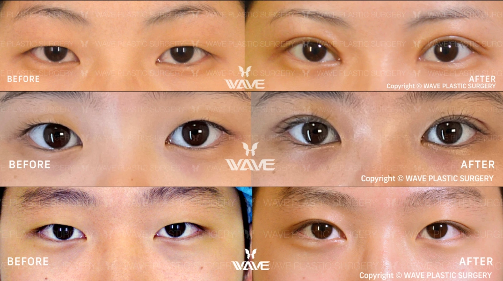 Wave Plastic Surgery - upper bleph - eyelid surgery