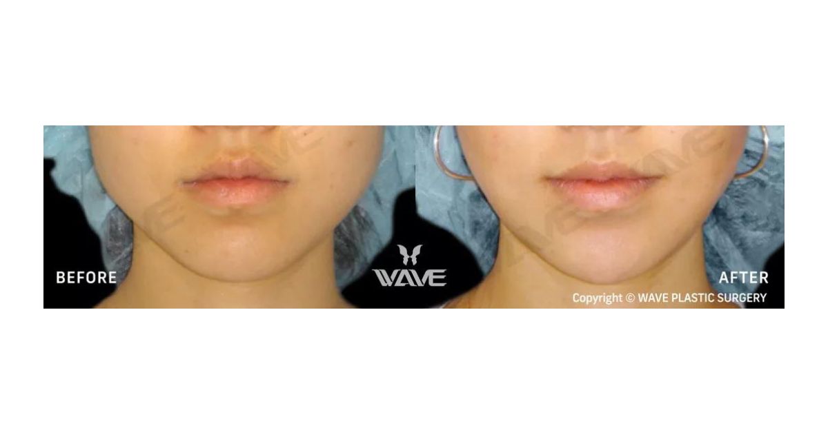 Wave Plastic Surgery - Jaw Reduction - Jaw Bone Shaving Surgery
