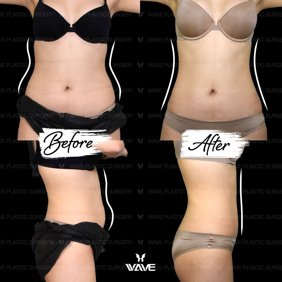 Wave Plastic Surgery - month of transformation