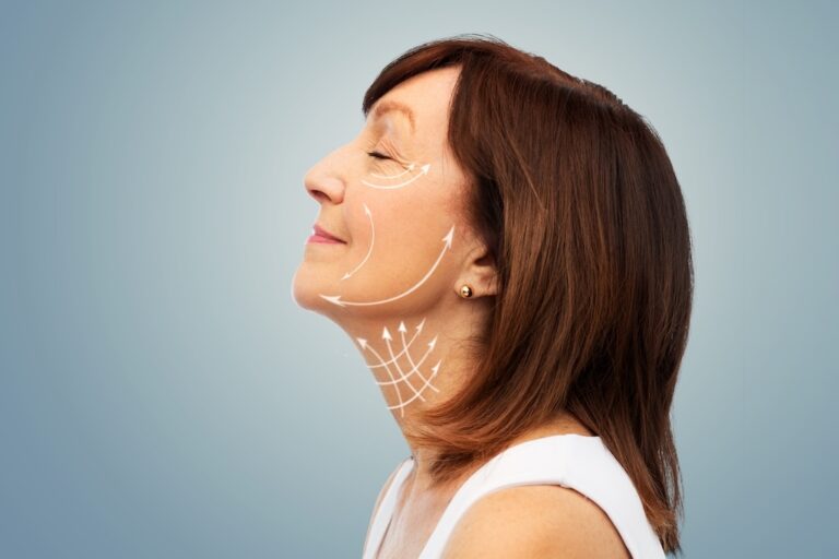 Woman with arrows on face representing the areas of a facelift