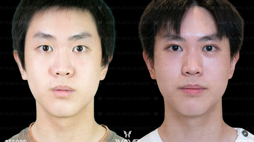 Specials Bepharoplasty special