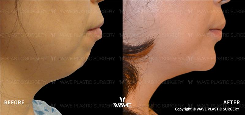 Specials Chin Augmentation 1 1