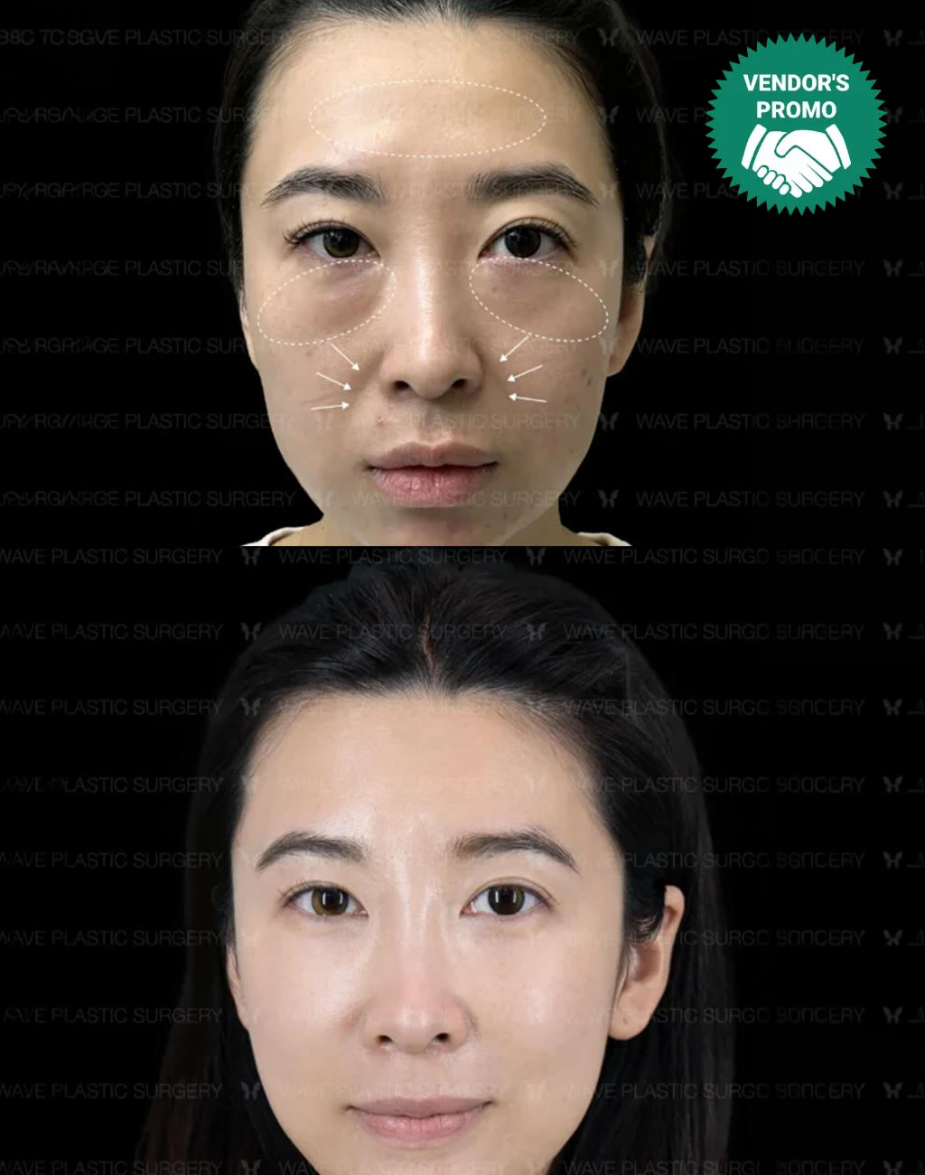 Specials Pyramid Rejuvenation Restylane Collection2​