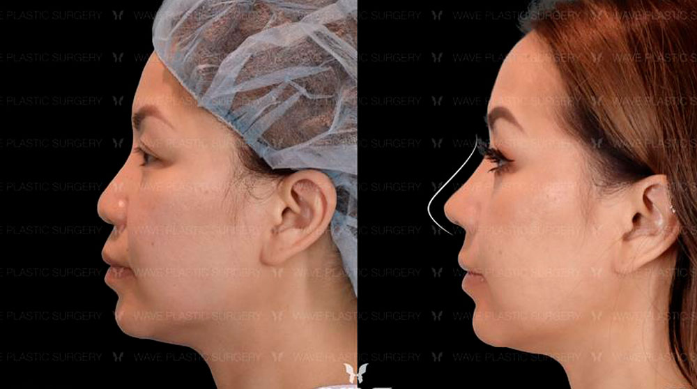 Specials Rhinoplasty special