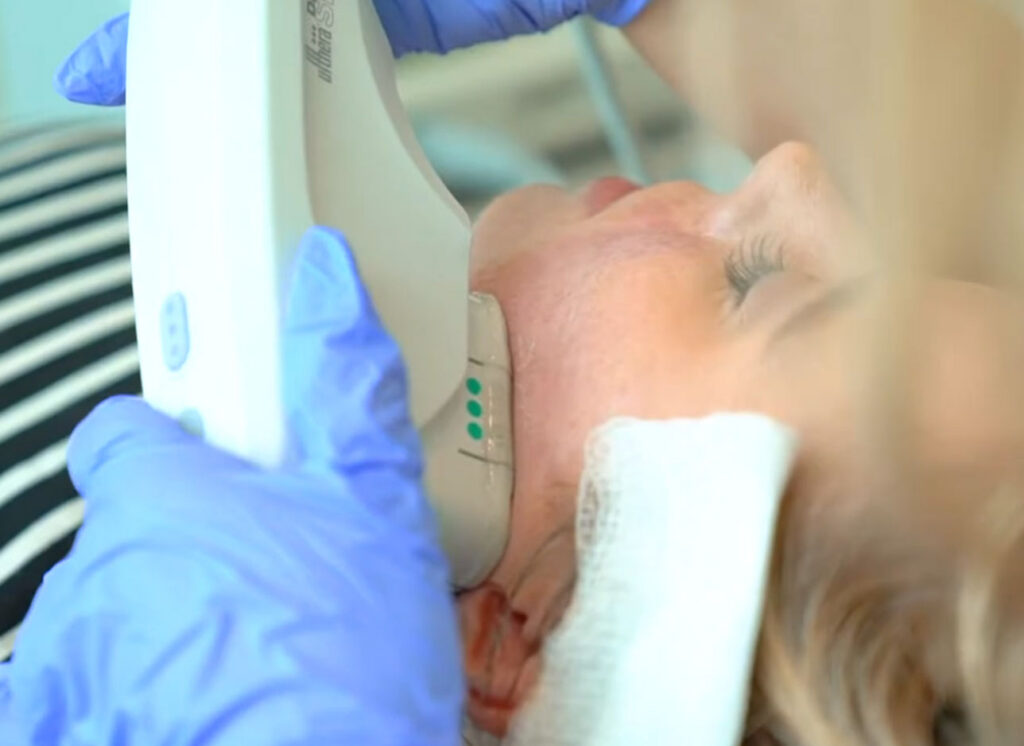 Ultherapy special ulth